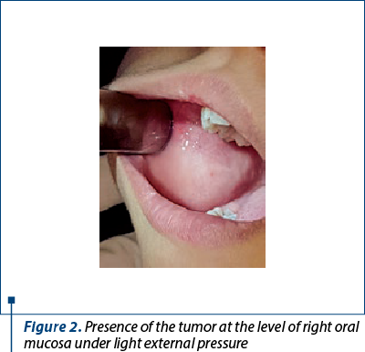 Figure 2. Presence of the tumor at the level of right oral mucosa under light external pressure
