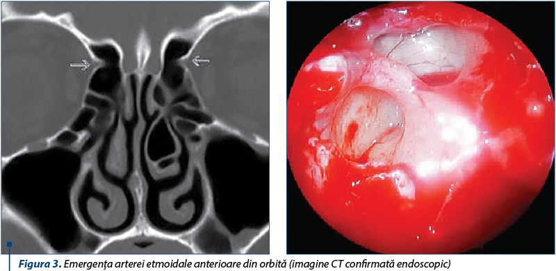 Figura 3. Emergenţa arterei etmoidale anterioare din orbită (imagine CT confirmată endoscopic) 