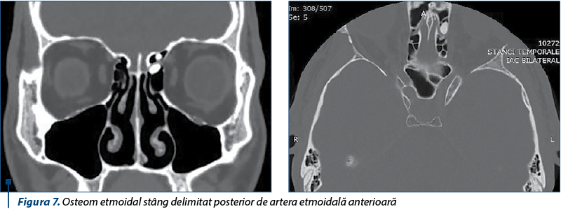 Figura 7. Osteom etmoidal stâng delimitat posterior de artera etmoidală anterioară