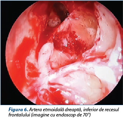 Figura 6. Artera etmoidală dreaptă, inferior de recesul frontalului (imagine cu endoscop de 70°)