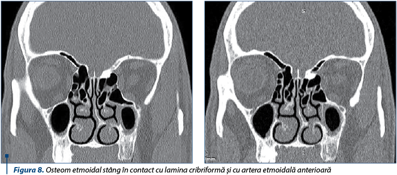 Figura 8. Osteom etmoidal stâng în contact cu lamina cribriformă şi cu artera etmoidală anterioară