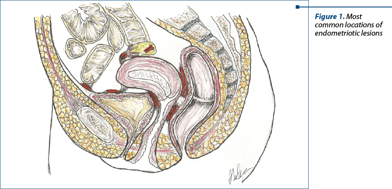 Figure 1. Most common locations of endometriotic lesions