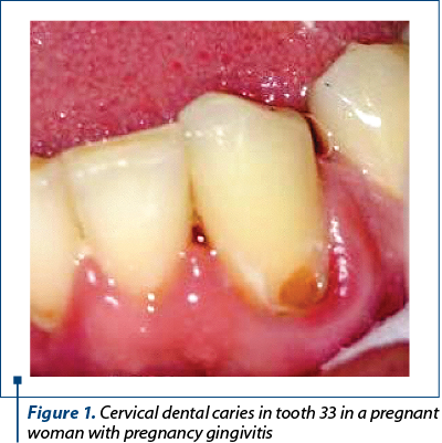 Figure 1. Cervical dental caries in tooth 33 in a pregnant woman with pregnancy gingivitis