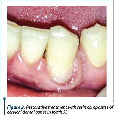 Figure 2. Restorative treatment with resin composites of cervical dental caries in tooth 33