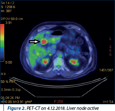 Figure 2. PET-CT on 4.12.2018. Liver node active