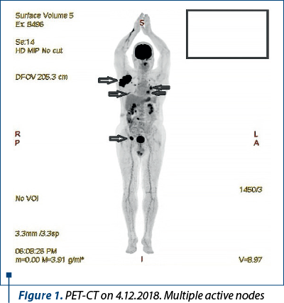 Figure 1. PET-CT on 4.12.2018. Multiple active nodes