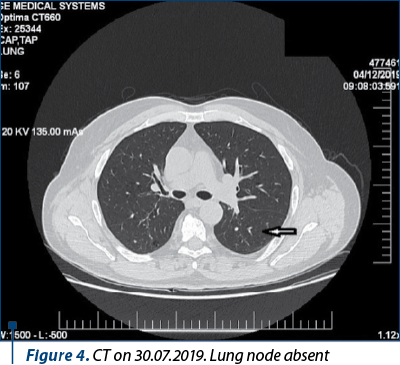 Figure 4. CT on 30.07.2019. Lung node absent