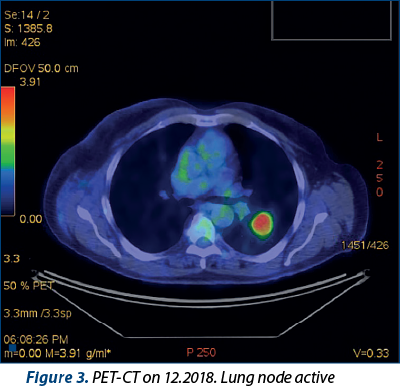Figure 3. PET-CT on 12.2018. Lung node active 
