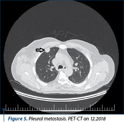 Figure 5. Pleural metastasis. PET-CT on 12.2018 