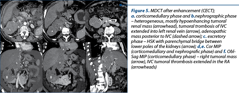 Figure 5. MDCT after enhancement (CECT);  a. corticomedullary phase and b.nephrographic phase – heterogeneous, mostly hypoenhancing tumoral renal mass (arrowhead), tumoral trombosis of IVC extended into left renal vein (arrow), adenopathic mass posterior to IVC (dashed arrow); c. excretory phase – HSK with parenchymal bridge between lower poles of the kidneys (arrow); d,e. Cor MIP (corticomedullary and nephrografic phase) and f. Obl-Sag MIP (corticomedullary phase) – right tumoral mass (arrow), IVC tumoral thrombosis extended in the RA (arrowheads)