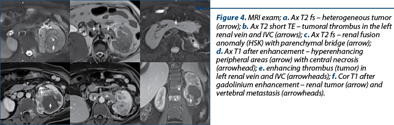 Figure 4. MRI exam; a. Ax T2 fs – heterogeneous tumor (arrow); b. Ax T2 short TE – tumoral thrombus in the left renal vein and IVC (arrows); c. Ax T2 fs – renal fusion anomaly (HSK) with parenchymal bridge (arrow);  d. Ax T1 after enhancement – hyperenhancing peripheral areas (arrow) with central necrosis (arrowhead); e. enhancing thrombus (tumor) in left renal vein and IVC (arrowheads); f. Cor T1 after gadolinium enhancement – renal tumor (arrow) and vertebral metastasis (arrowheads).