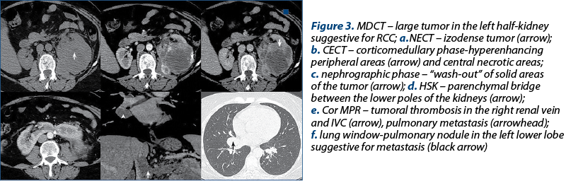 Figure 3. MDCT – large tumor in the left half-kidney suggestive for RCC; a.NECT – izodense tumor (arrow); b. CECT – corticomedullary phase-hyperenhancing peripheral areas (arrow) and central necrotic areas;  c. nephrographic phase – “wash-out” of solid areas of the tumor (arrow); d. HSK – parenchymal bridge between the lower poles of the kidneys (arrow);  e. Cor MPR – tumoral thrombosis in the right renal vein and IVC (arrow), pulmonary metastasis (arrowhead);  f. lung window-pulmonary nodule in the left lower lobe suggestive for metastasis (black arrow)