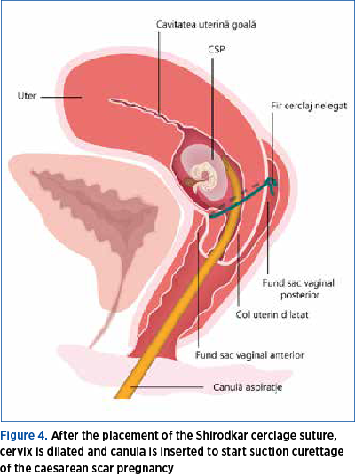 Figure 4. After the placement of the Shirodkar cerclage suture, cervix is dilated and cannula is inserted to start suction curettage of the caesarean scar pregnancy