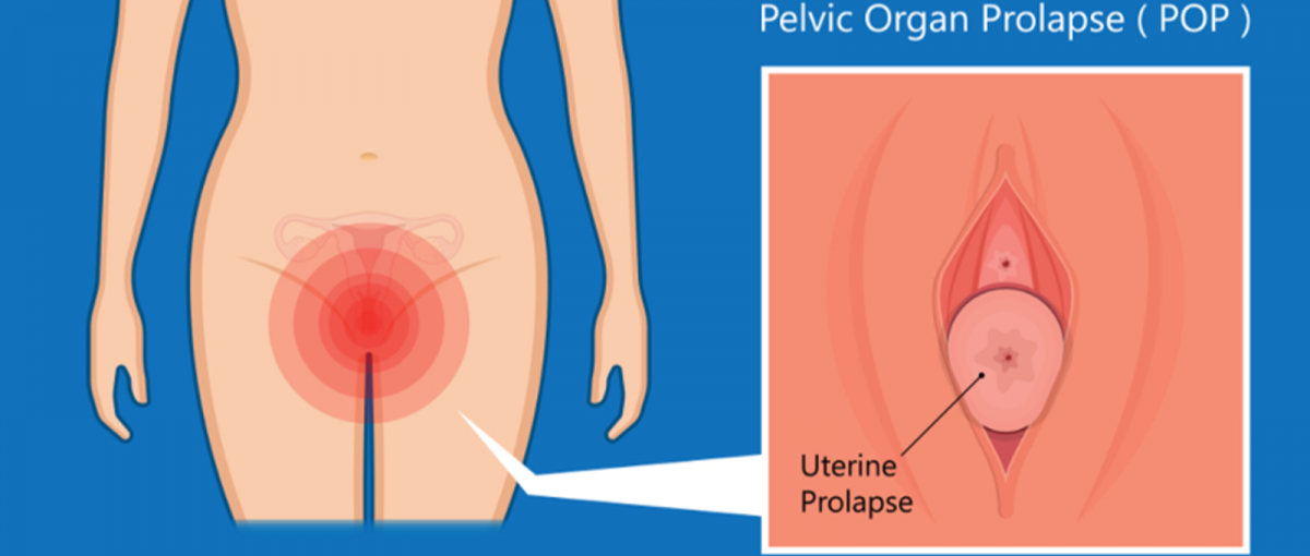 poate pierderea în greutate cauza prolaps uterin