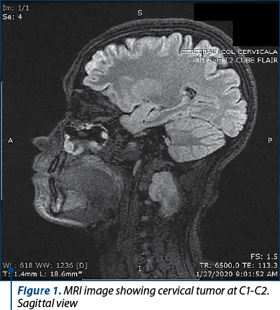 Figure 1. MRI image showing cervical tumor at C1-C2. Sagittal view