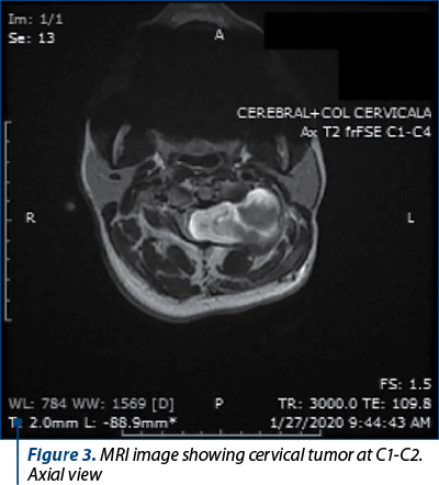 Figure 3. MRI image showing cervical tumor at C1-C2. Axial view