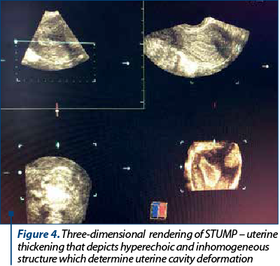 Figure 4. Three-dimensional  rendering of STUMP – uterine thick­e­ning that depicts hyperechoic and inhomo­geneous structure which determine uterine cavity deformation