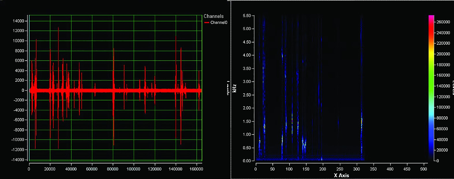Figurile 12 și 13. La pacientul cu voce de hipofaringe se constată doar modulaţii sporadice în durată, greu sincronizate, fără a putea genera un spectru sonor minimal