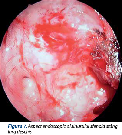 Figura 7. Aspect endoscopic al sinusului sfenoid stâng larg deschis