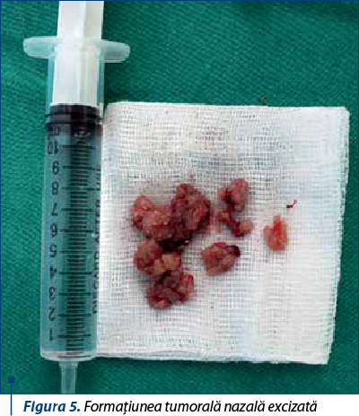 Figura 5. Formaţiunea tumorală nazală excizată