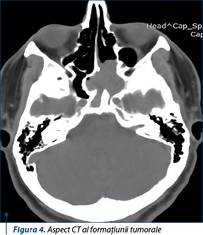 Figura 4. Aspect CT al formaţiunii tumorale