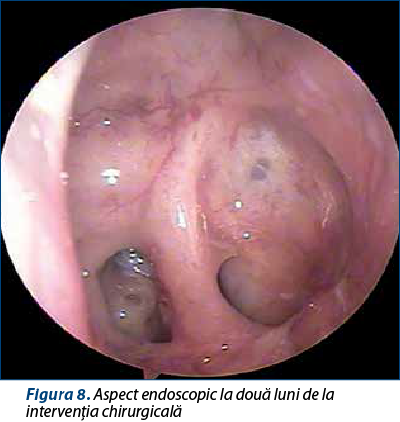 Figura 8. Aspect endoscopic la două luni de la intervenţia chirurgicală