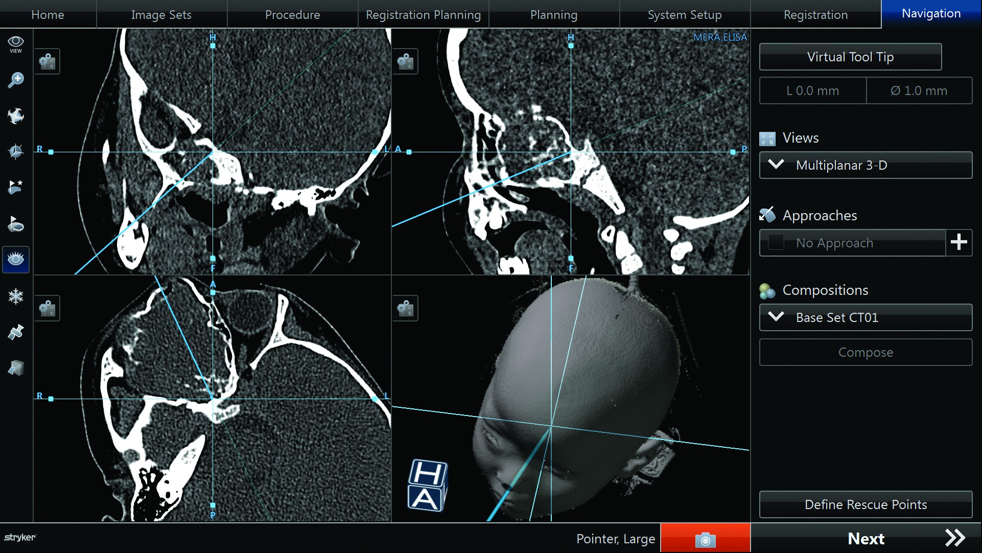Figura 1. Utilizarea  sistemului de navigație chirurgicală computerizată - imagini intraoperatorii