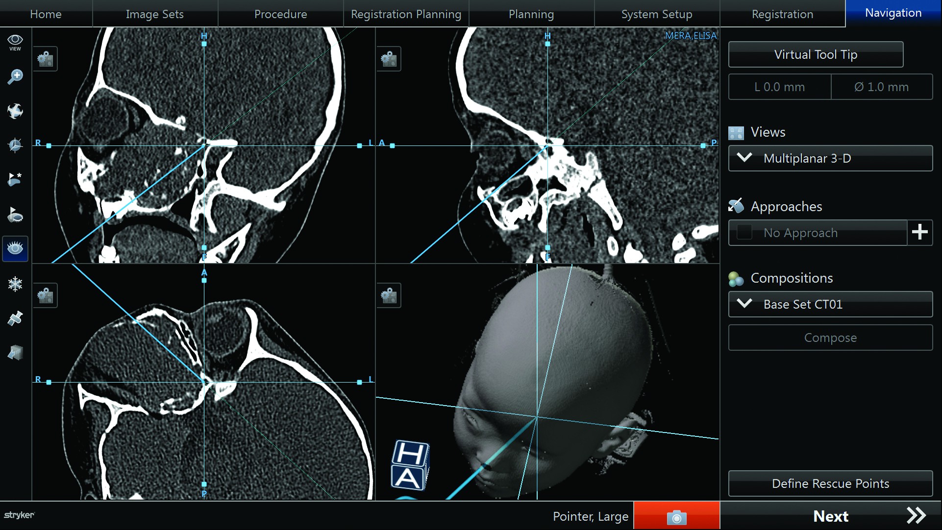 Figura 1. Utilizarea  sistemului de navigație chirurgicală computerizată - imagini intraoperatorii