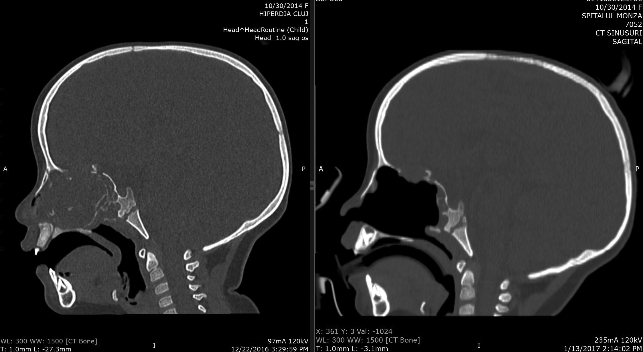 Figura 2. Examen CT  pre- și postoperator