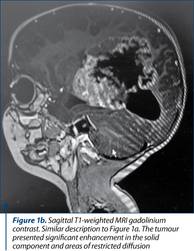 Figure 1b. Sagittal T1-weighted MRI gadolinium contrast. Similar description to Figure 1a. The tumour presented significant enhancement in the solid component and areas of restricted diffusion
