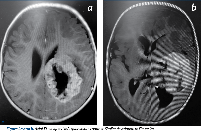 Figure 2a and b. Axial T1-weighted MRI gadolinium contrast. Similar description to Figure 2a