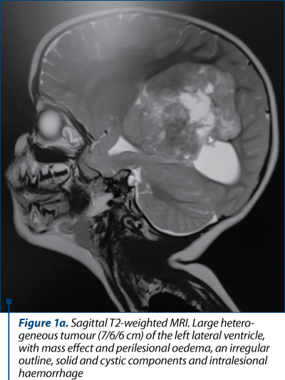 Figure 1a. Sagittal T2-weighted MRI. Large hetero­ge­neous tumour (7/6/6 cm) of the left lateral ventricle, with mass effect and perilesional oedema, an irregular outline, solid and cystic components and intralesional haemorrhage 