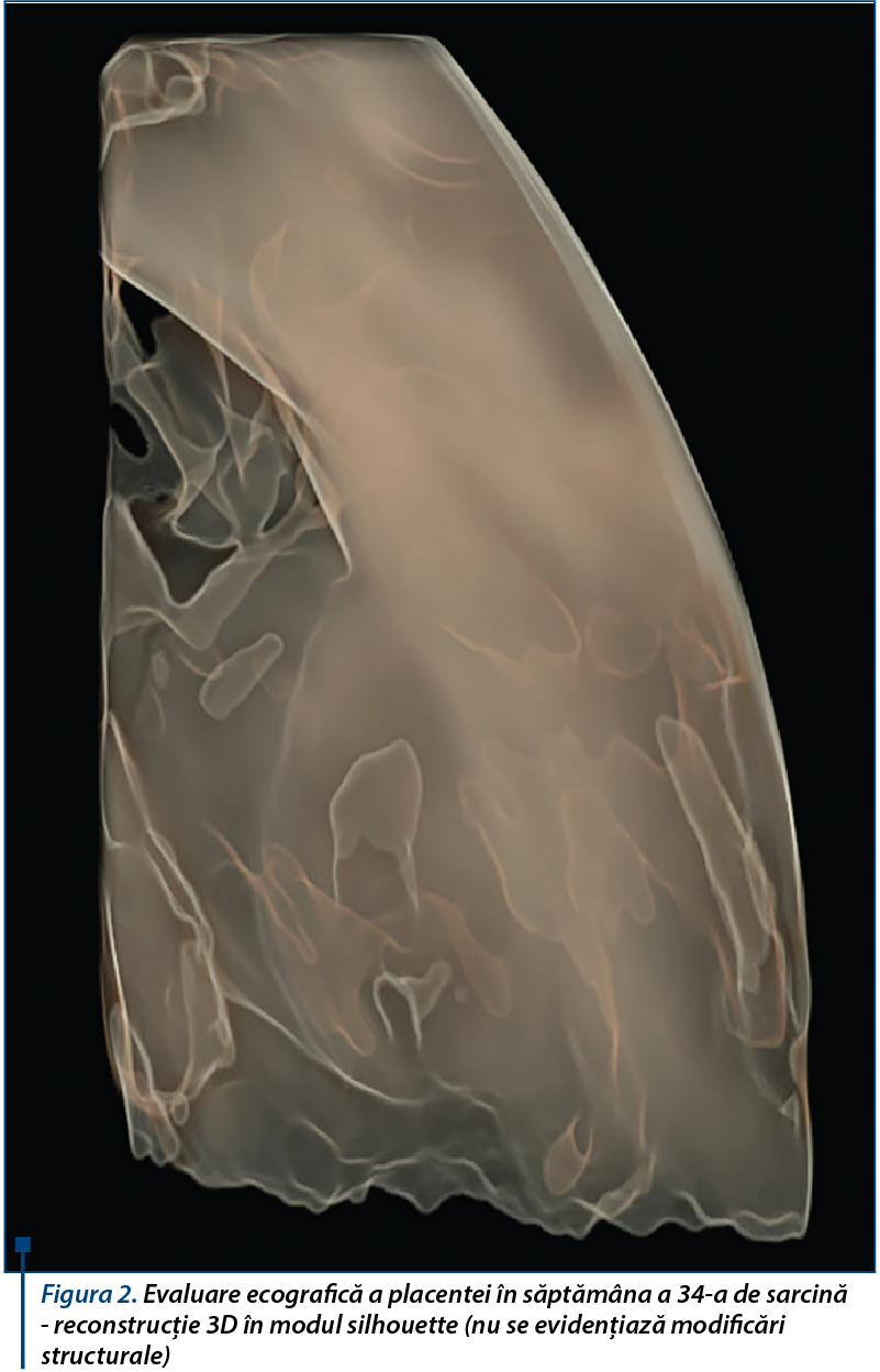 Figura 2. Evaluare ecografică a placentei în săptămâna a 34-a de sarcină - reconstrucţie 3D în modul silhouette (nu se evidenţiază modificări structurale)