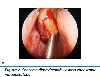 Figura 2. Concha bullosa dreaptă – aspect endoscopic intraoperatoriu