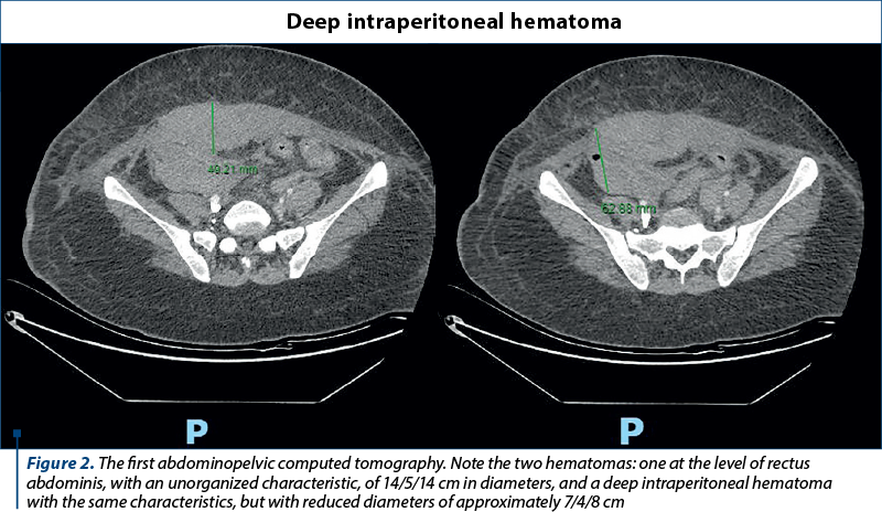 Figure 2. The first abdominopelvic computed tomography. Note the two hematomas: one at the level of rectus abdominis, with an unorganized characteristic, of 14/5/14 cm in diameters, and a deep intraperitoneal hematoma  with the same characteristics, but with reduced diameters of approximately 7/4/8 cm