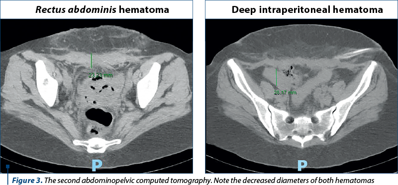 Figure 3. The second abdominopelvic computed tomography. Note the decreased diameters of both hematomas