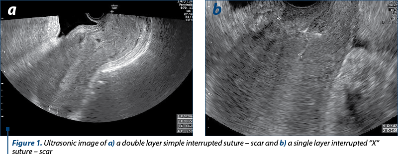 Figure 1. Ultrasonic image of a) a double layer simple interrupted suture – scar and b) a single layer interrupted “X” suture – scar