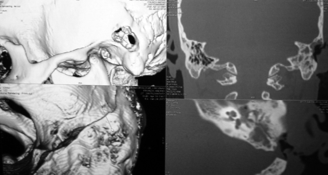 Figura 2. CT 3D - defect osos  postoperator cu prezența masivului osos între fosa craniană medie  și posterioară