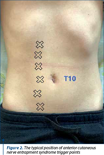 Figure 2. The typical position of anterior cutaneous nerve entrapment syndrome trigger points