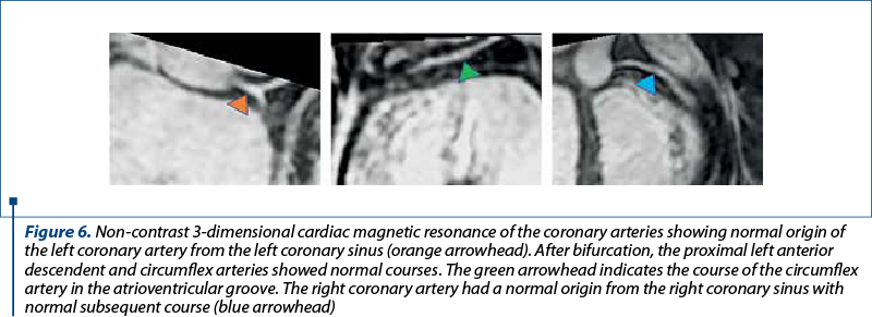 Figure 6. Non-contrast 3-dimensional cardiac magnetic resonance of the coronary arteries showing normal origin of the left coronary artery from the left coronary sinus (orange arrowhead). After bifurcation, the proximal left anterior descendent and circumflex arteries showed normal courses. The green arrowhead indicates the course of the circumflex artery in the atrioventricular groove. The right coronary artery had a normal origin from the right coronary sinus with normal subsequent course (blue arrowhead)