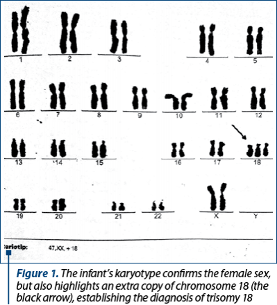 Figure 1. The infant’s karyotype confirms the female sex, but also highlights an extra copy of chromosome 18 (the black arrow), establishing the diagnosis of trisomy 18