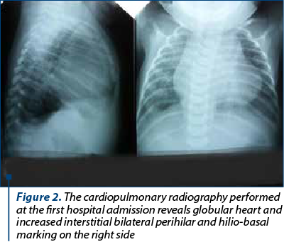 Figure 2. The cardiopulmonary radiography performed at the first hospital admission reveals globular heart and increased interstitial bilateral perihilar and hilio-basal marking on the right side