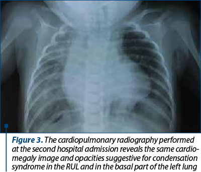 Figure 3. The cardiopulmonary radiography performed at the second hospital admission reveals the same cardio­megaly image and opacities suggestive for condensation syndrome in the RUL and in the basal part of the left lung