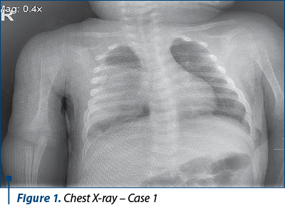 Figure 1. Chest X-ray – Case 1