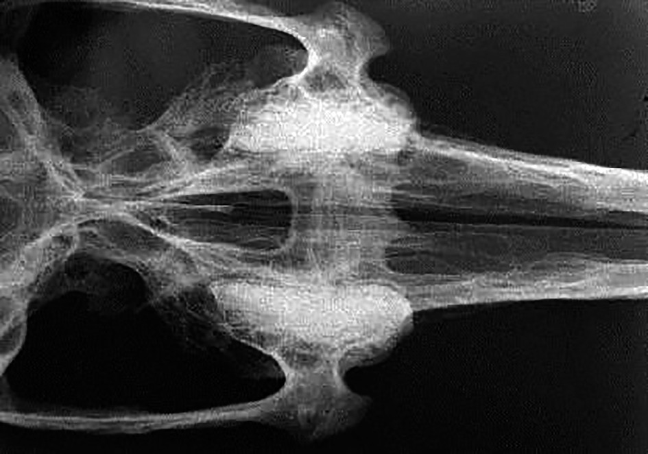 Figure 4. Axial angulation X ray obtained after disjunctor removal 