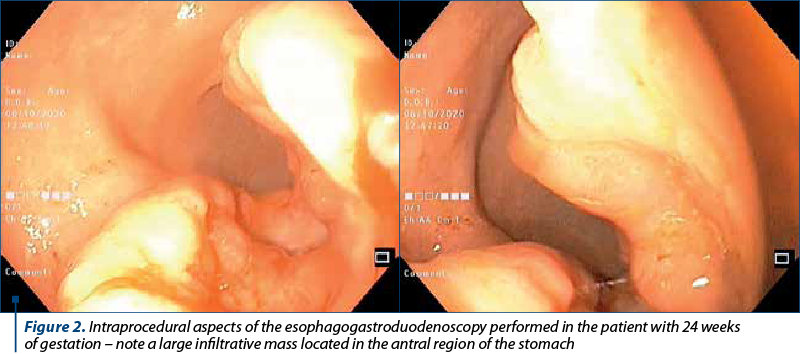 Figure 2. Intraprocedural aspects of the esophagogastroduodenoscopy performed in the patient with 24 weeks  of gestation – note a large infiltrative mass located in the antral region of the stomach