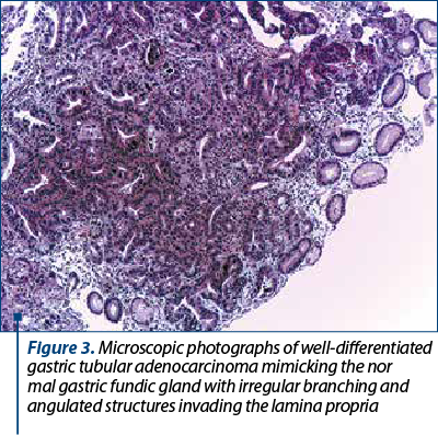 Figure 3. Microscopic photographs of well-differentiated gastric tubular adenocarcinoma mimicking the nor­mal gastric fundic gland with irregular branching and angu­lated structures invading the lamina propria. Hematoxylin-eosin staining, ob. 10x