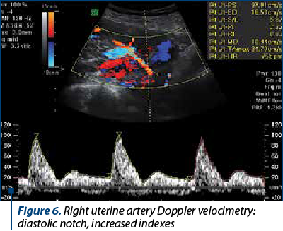 Figure 6. Right uterine artery Doppler velocimetry: diastolic notch, increased indexes