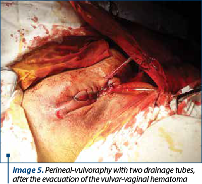 Image 5. Perineal-vulvoraphy with two drainage tubes, after the evacuation of the vulvar-vaginal hematoma
