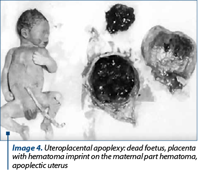 Image 4. Uteroplacental apoplexy: dead foetus, placenta with hematoma imprint on the maternal part hematoma, apoplectic uterus